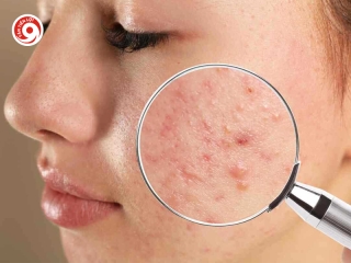 Uống Trà Sữa Có Nổi Mụn Không? Cách Uống Không Bị Mụn